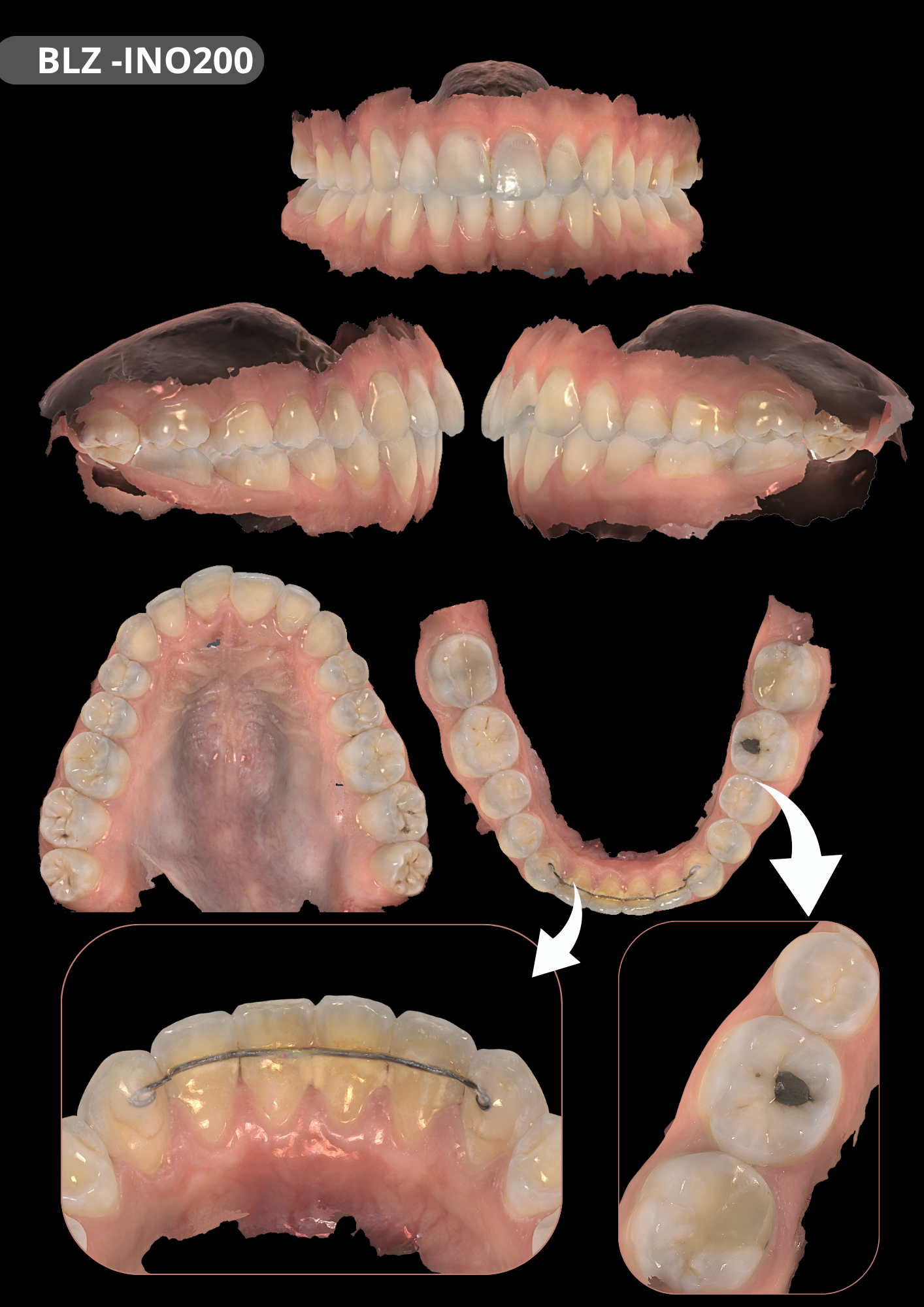 INO 200 Smart Dent  BLZDental