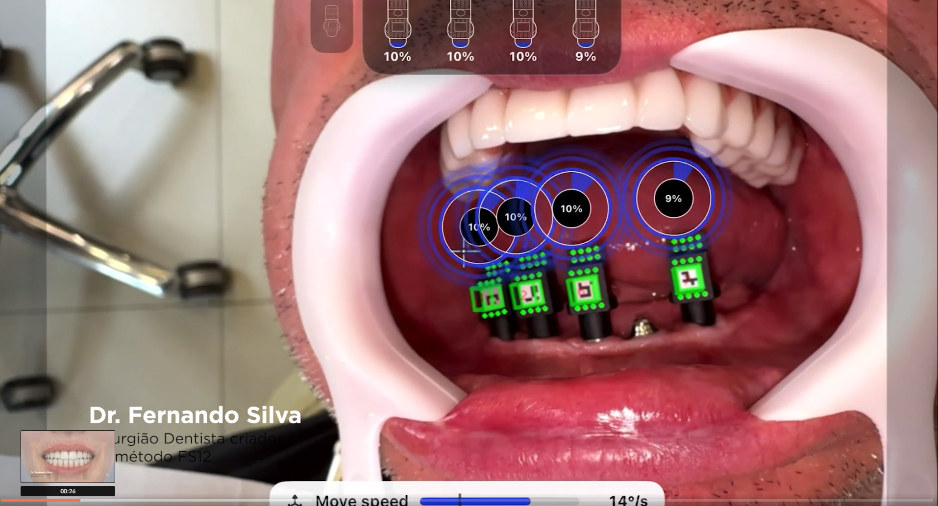 O T-Marker All-on-T da TruAbutment